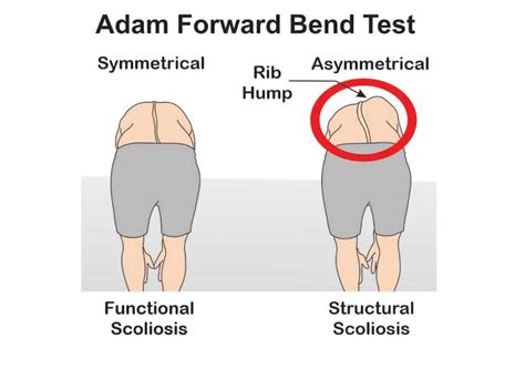 adams forward bend test symptoms